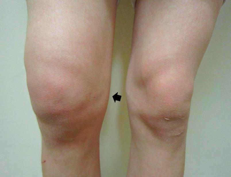 Εικόνα 9.19 Ύδραρθρο (https://commons.wikimedia.org/wiki/file:kneeffusion.jpg?