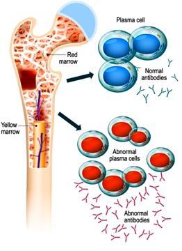 Πλασματοκυτταρικές δυσκρασίες/παραπρωτεϊναιμίες Οι πλασματοκυτταρικές δυσκρασίες αφορούν