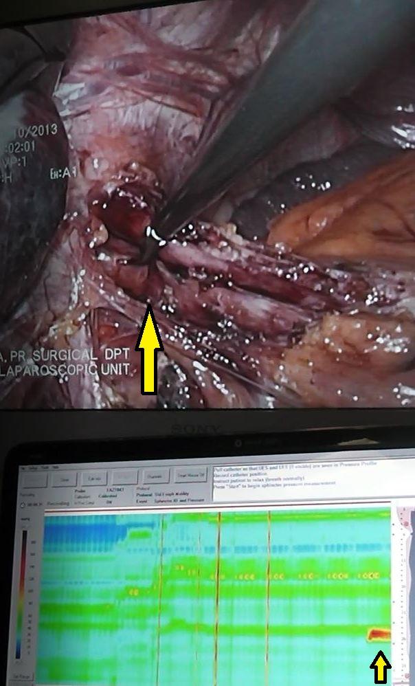 Εικόνα 31. Εντοπισμός σημείου ζώνης αυξημένης πίεσης στην καρδιοοισοφαγική συμβολή μετά το πέρας της μυοτομής. Μεγάλο κίτρινο βέλος, καρδιοοισοφαγική συμβολή.