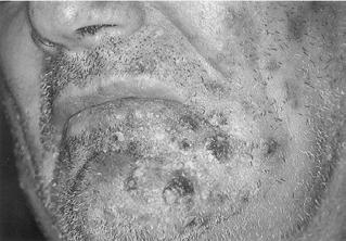 pneumoniae 7-18x γενικού πληθυσμού (μικροβιαιμία 100x),