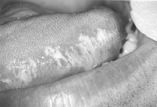 ΕΚ ΗΛΩΣΕΙΣ ΑΠΟ ΤΟ ΠΕΠΤΙΚΟ Οισοφαγίτιδα (candida, CMV, HSV) υσφαγία, οπισθοστερνικό άλγος, ανορεξία, απώλεια βάρους Αλιθιασική χολοκυστίτιδα ιδιοπαθής 55%, CMV, κρυπτοσπορίδια Σκληρυντική