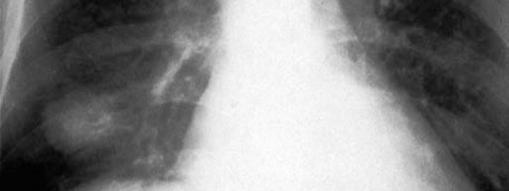 συμφύσεις, ενδοφθαλμίτιδα Cryptococcal pneumonia.