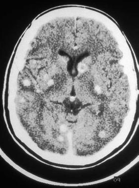 CT scan of previously healthy patient with multiple cryptococcomas