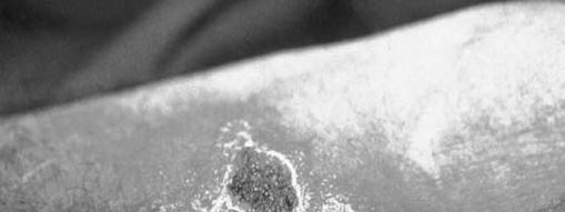 Severely immunosuppressed
