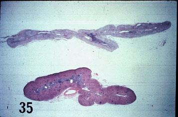 Νόσος του Addison Φλοιοεπινεφριδιακή ανεπάρκεια Καταστροφή του φλοιού: φυµατίωση,