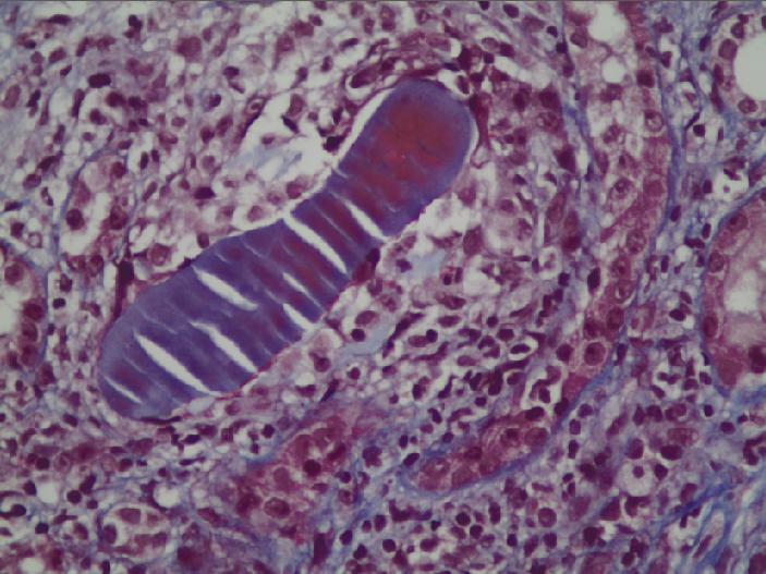 Myeloma Kidney)