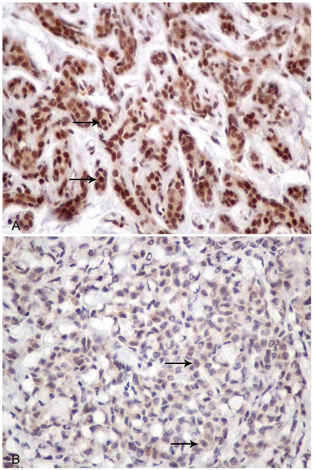 69 Διηθητικό πορογενές καρκίνωμα, Grade II (A) και Grade III (B).