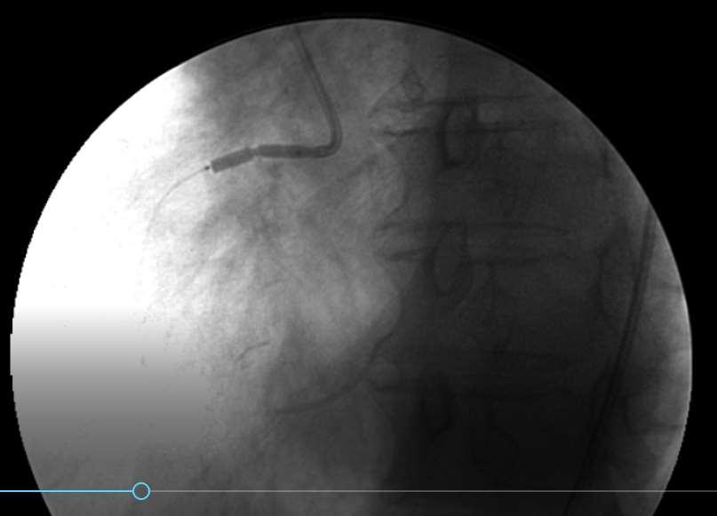 Stent RCA