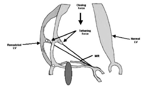 ICM-DCM Tethering forces Annular dilatation LV dilatation Papillary muscles (PM) displacement LV sphericity Closing forces LVEF Global LV dyssynchrony PM