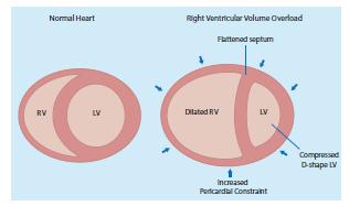 Right ventricular function Evaluation of the RV is difficult because of its complex anatomical