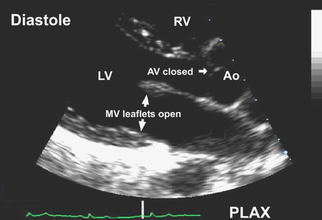 SWTd LVIDd PWTd TEI index Systolic AND diastolic cardiac Fx Left AND Right cardiac Fx Correlates with LV dp/dt (cath lab) Prognostic value in PHTN, infiltrative CM, DCM,