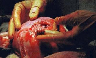 Το χέρι της Ελπίδας-Ένας όμορφος ύμνος προς τη ζωή Η φωτογραφία είναι ενός μωρού 21 εβδομάδων, πριν ακόμη γεννηθεί, το όνομα του οποίου είναι Samuel Armas και είχε διαγνωστεί ότι πάσχει από