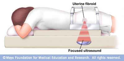 Interventional Radiology Magnetic Resonance guided Focused Ultrasound περιορισμένη χρήσημικρά ινομυώματα