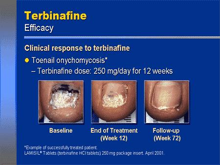 Κλινικές ενδείξεις για χορήγηση τερμπιναφίνης δραστική στην