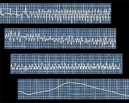 3.2 Διαχωρισμός με βάση το ΗΚΓ Μη εμμένουσα κοιλιακή ταχυκαρδία: Τρεις ή περισσότερες συστολές κοιλιακής προέλευσης, συχνότητας μεγαλύτερης από 100 bpm, που τερματίζεται αυτόματα σε λιγότερο από 30