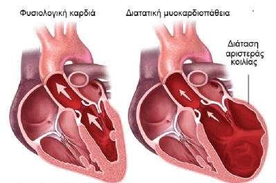 6.3.2 Διατατική μυοκαρδιοπάθεια Είναι πάθηση του μυοκαρδίου που χαρακτηρίζεται από διάταση των καρδιακών κοιλοτήτων κυρίως της αριστερής κοιλίας με συστολική δυσλειτουργία αυτής.