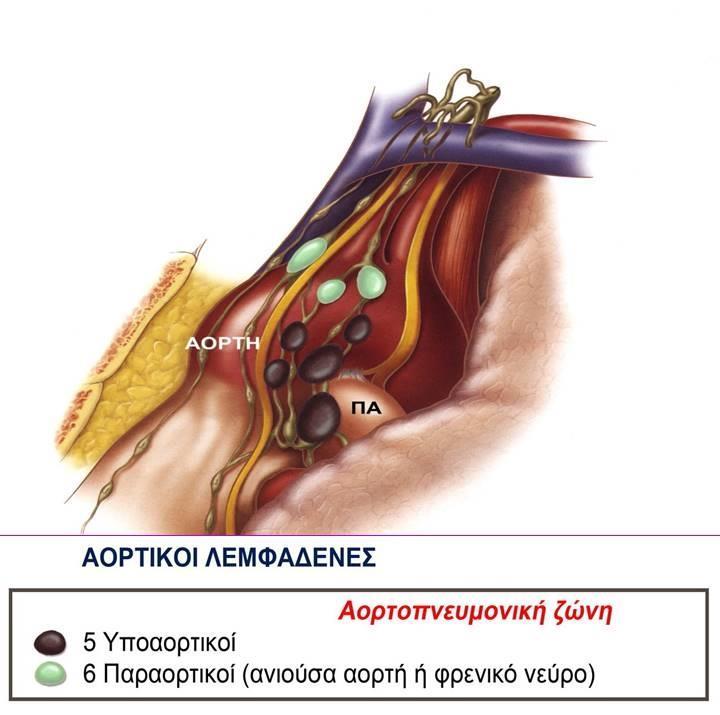 λεμφαδένων του θώρακος.