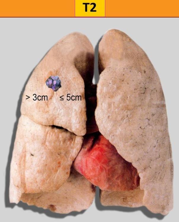 - προσβολή του κύριου βρόγχου (όχι της τρόπιδας) - συνοδεύεται από ατελεκτασία που εκτείνεται έως τη πύλη του πνεύμονος (Εικόνα 1) 40 Ο όγκος Τ2 διαχωρίζεται σε υποκατηγορίες Τ2α και Τ2b: Ως Τ2a