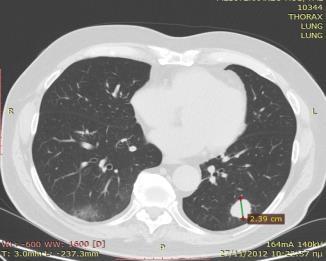 [9] (Εικόνα 7,8) 42 Οι κλινικές επιδράσεις της νέας σταδιοποίησης του καρκίνου του πνεύμονος όσον αφορά τον παράγοντα Τ συνίστανται στα εξής: Κάθε cm έχει τη σημασία του διότι καθορίζει το στάδιο Η