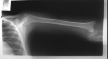 Προβολή 8η Το μειονέκτημα της ακτινογραφίας αφορά την απαγωγή του βραχιονίου ενώ είναι εμφανής η βλάβη στην άρθρωση του αγκώνα.