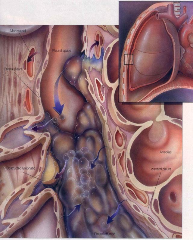 Pleiras patoloģija Tuberkulozs pleirīts Mezotelioma Plaušu patoloģija Pneimonija Plaušu