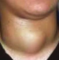 ناقش: انخفاض السكر في الدم عن المستوى الطبيعي ا كثر خطورة من ارتفاعه. 2- تضخم الغدة الدرقية :(Goiter) يحدث نتيجة لزيادة في حجم الغدة الدرقية (تضخم).