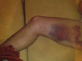106 الا جهاد العضلي Strain) :(Muscle يحدث الا جهاد العضلي نتيجة للشد القوي في العضلات ا و تمزقها ا و الا فراط في استخدامها ا و ا عيائها مما يسبب الا لم ومحدودية الحركة في العضلة المصابة ويمكن ا ن