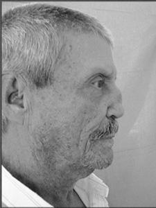 Η ΡΙΝΑ Ρινικός βλεννογόνος διηθημένος από βάκιλλους & κύτταρα Η αποβαλλόμενη βλέννα περιέχει αφθονότατους βακίλλους +/ εξέλκωση βλενογόνου Μπορεί να παρατηρηθεί καταστροφή του ρινικού διαφράγματος