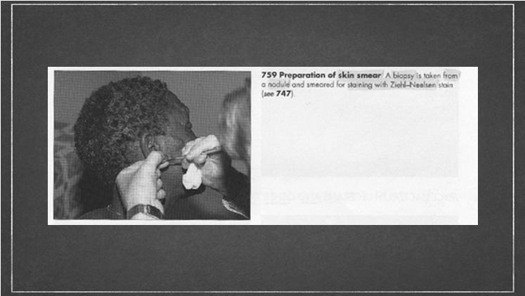 Εξέταση επιχρίσματος από σχάση δέρματος (Skin slit smear) Η σημαντικότερη μέθοδος για τη διάγνωση της πλειοβακιλλικης μορφής (multibacillary disease) Στη λεπρωματώδη λέπρα (LL) μπορεί να ανευρεθούν
