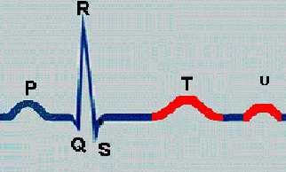 Unda T Reflectă repolarizarea ventriculară (epicard endocard); Aspect: rotunjită, asimetrică, cu panta descendentă mai abruptă; Sens: concordant cu complexul QRS - pozitivă în majoritatea