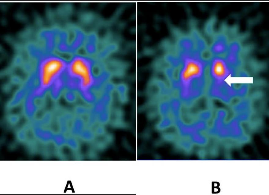 Zobrazovacie vyšetrenia CT / MRI mozgu pri štandardnom vyšetrení nález v norme realizuje sa z dif.dg.