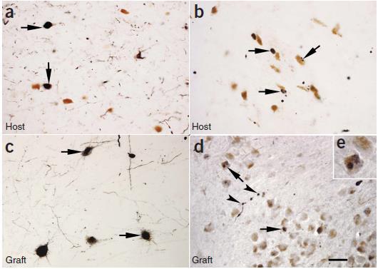 Prion-like mechanizmus šírenia