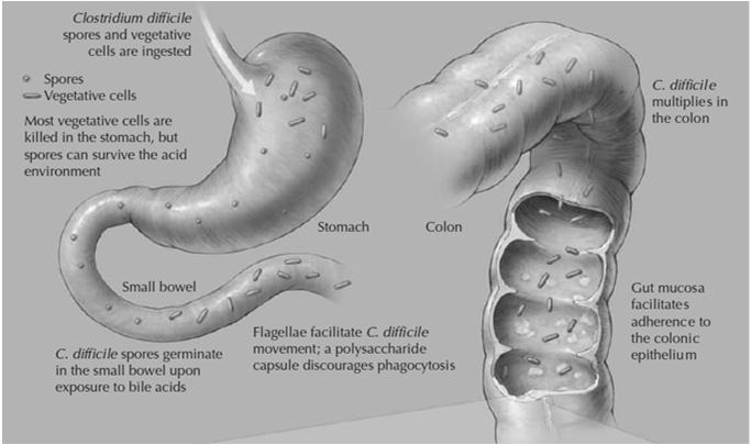 difficile infection CMAJ 2004;171(1):51 8 27