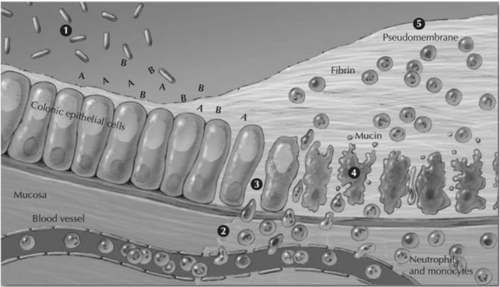 C. difficile infection CMAJ 2004;171(1):51