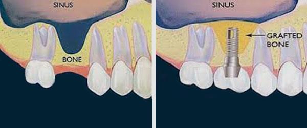 Ανύψωση Εδάφους Ιγμόρειου Άντρου Στις περιπτώσεις που θέλουμε να αποκαταστήσουμε επιεμφυτευματικά μια νωδότητα της οπίσθιας περιοχής της άνω γνάθου (κυρίως περιοχή γομφίων) με οδοντικά εμφυτεύματα,