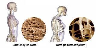 εκατομμύρια κατάγματα σε ευρωπαίους άνδρες και γυναίκες (Εικόνα 1.2) (Kanis & Johnell, 2005). Εικόνα 1.2: Απεικόνιση Φυσιολογικού Οστού και Οστού με Οστεοπόρωση (https://www.google.com.cy/search?