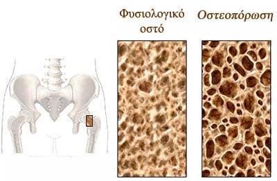 Εικόνα 1.1: Απεικόνιση Φυσιολογικού Οστού και Οστεοπόρωσης (http://www.paidoreumatologos.
