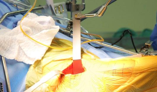 Position second curved arm in the second joint on the crossbar in the same manner. TIP: Keep the lateral curved arm as low as possible so that it does not interfere when broaching the femur.