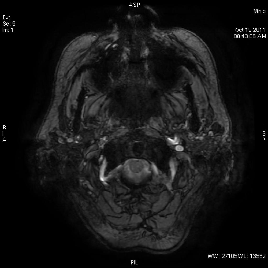 SWI ehk Susceptibility Weighted Imaging 3D spoiled-gre tehnika Kasutatakse ära GRE signaalikadu mida põhjustab deoksühemoglobiin (lühenenud T2* kujutisel