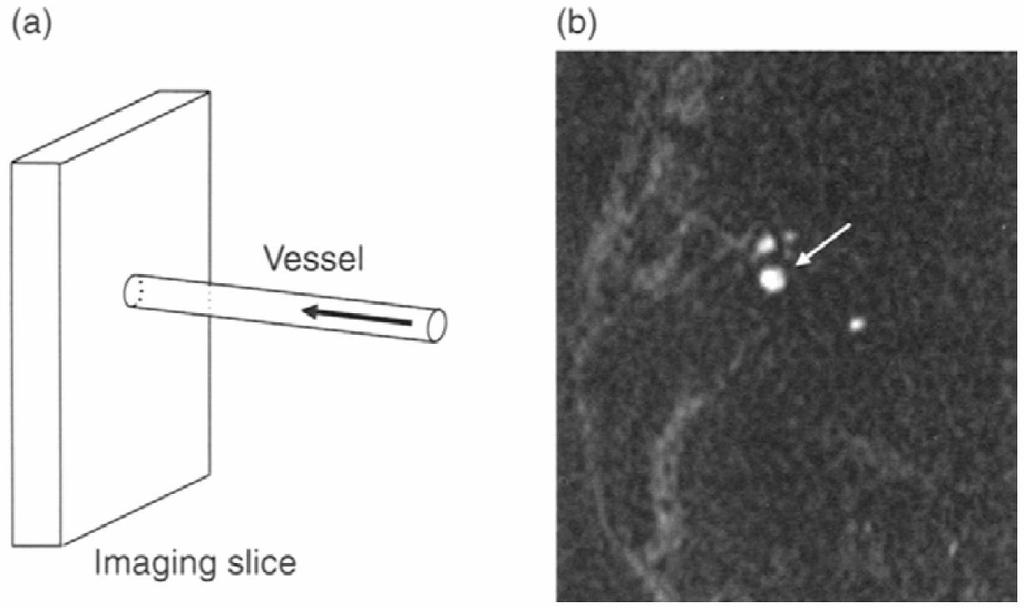 Sissevooluefekt Backens, Schmitz Unenhanced MR Angiography, p7 Veri, mis jääb kihist väljapoole ei ole RF pulssidest mõjutatud Veri mis jõuab kihti, on pea täielikult relakseerunud võrreldes kihis