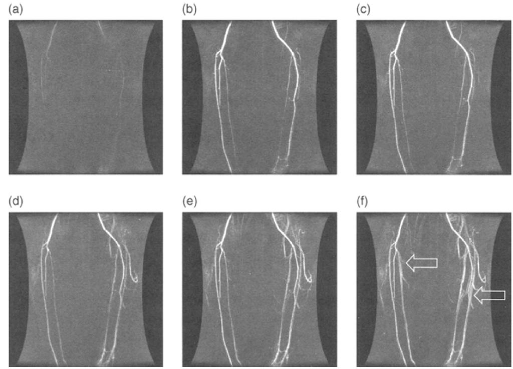 TRICKS meetod Time Resolved Imaging of Contrast Kinetcs CEMRA multi-faasiline programm Kujutised kontrastaine dünaamikast nii arteriaalses kui venoosses faasis Mask faas Kontrastaine süstimine +
