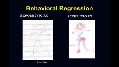 PANDAS Pediatric Autoimmune Neuropsychiatric