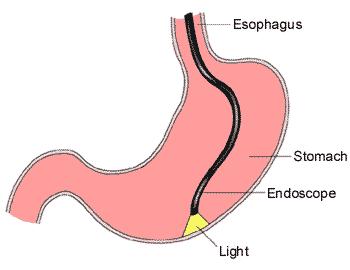 Με την ενδοσκόπηση εχουμε την δυνατότητα να δούμε το ανώτερο πεπτικό μεχρι την 4η