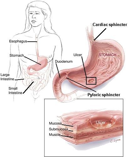 Πίνακας 1 : Helicobacter pylori λοίμωξη NSAIDs Γαστρίτιδα άντρου γαστρίνης η/και σωματοστατίνης έκκριση HCL (διατήρηση υγιούς σώματος τοιχωματικών κυττάρων Διάχυτη γαστρίτιδα (σώμα + αντρο) Ατροφία