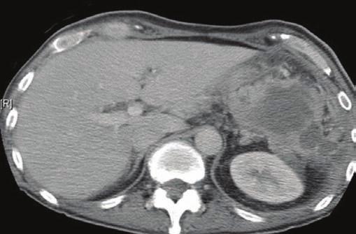 Η ERCP διενεργείται συνήθως εκλεκτικά σε ασθενείς με απόφραξη, στένωση ή νεόπλασμα των χοληφόρων ή του παγκρέατος.