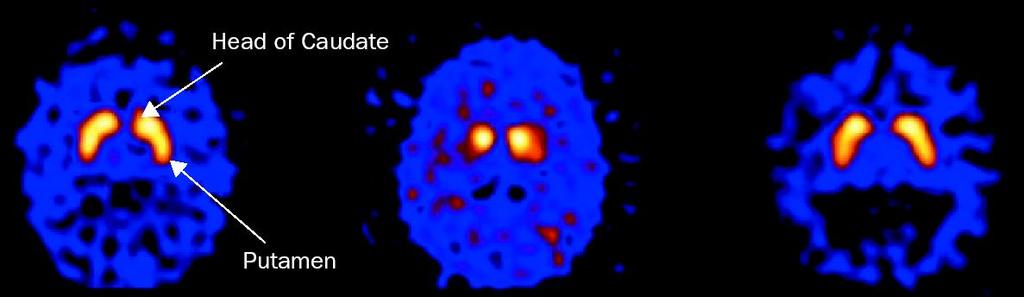 Σπινθηρογράφημα Εγκεφάλου fluoropropyl-cit SPECT [DAT scan] CONTROL