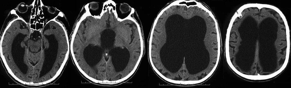 MRI: NPH