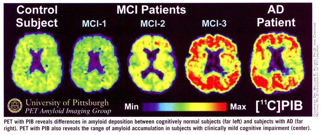 PET: AMYLOID IMAGING Pittsburgh Compound B (PIB) N-methyl-[11C]2-(4