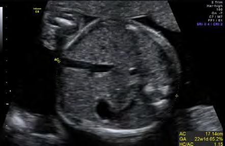 ΚΑΤΕΥΘΥΝΤΗΡΙΕΣ ΟΔΗΓΙΕΣ ΕΕΥΜΓ 4 Περίμετρος κεφαλής του εμβρύου (HC) Ενδεδειγμένη τομή (εικόνα 23).