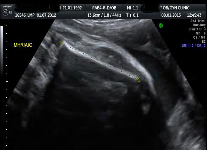 ΚΑΤΕΥΘΥΝΤΗΡΙΕΣ ΟΔΗΓΙΕΣ ΕΕΥΜΓ 5 Μήκος μηριαίου οστού του εμβρύου (FL) Ενδεδειγμένη τομή (εικόνα 27) Το μηριαίο οστό θα πρέπει να απεικονίζεται με τέτοιο τρόπο ώστε και οι δύο οστεοποιημένες διαφύσεις